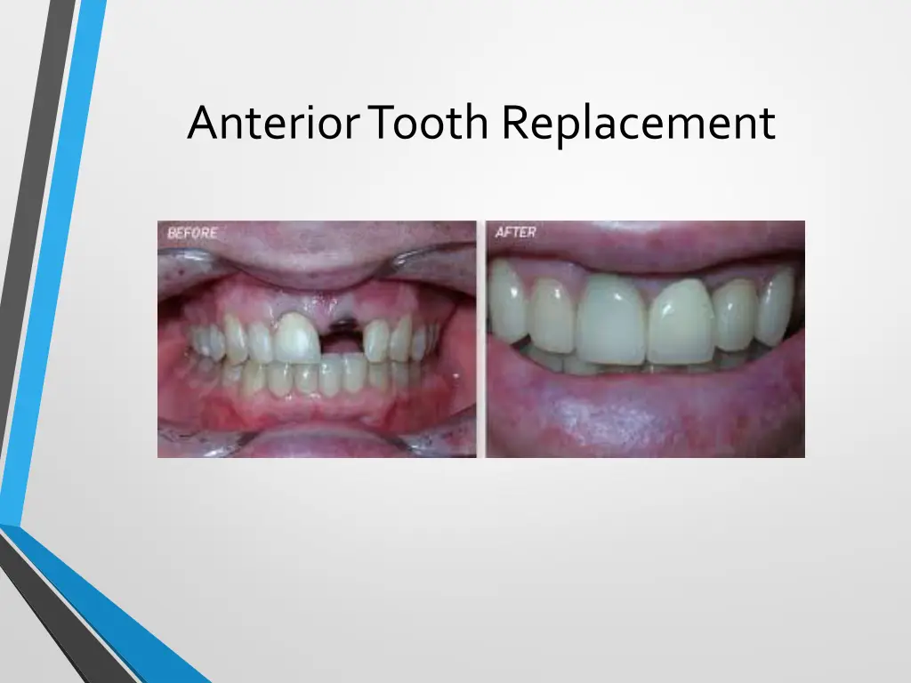 anterior tooth replacement