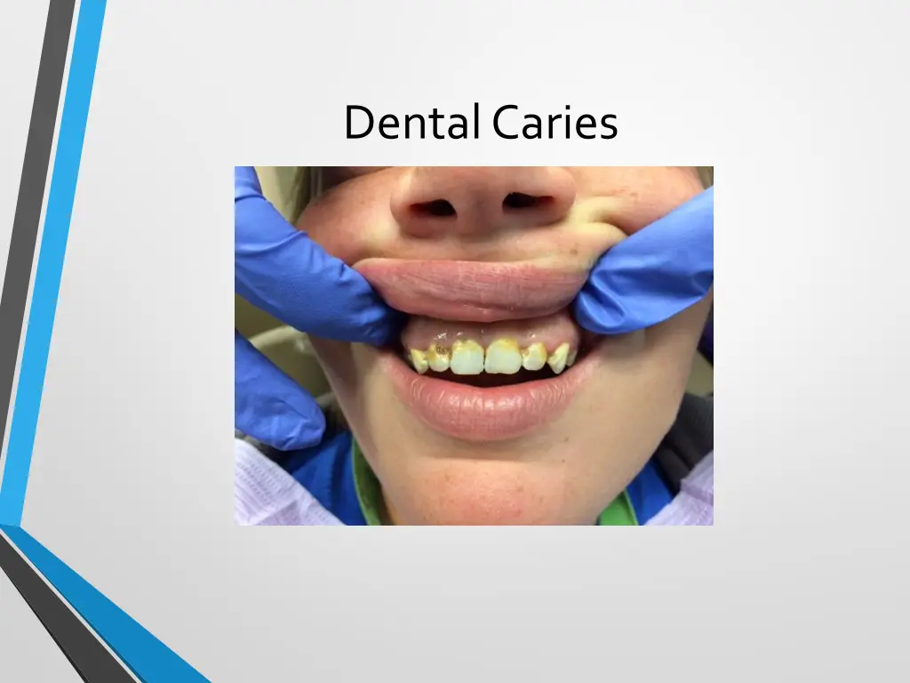 dental caries