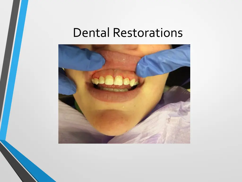 dental restorations