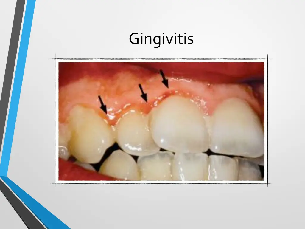 gingivitis