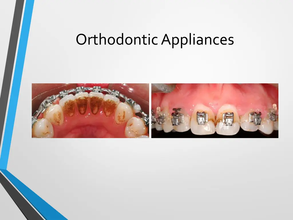 orthodontic appliances