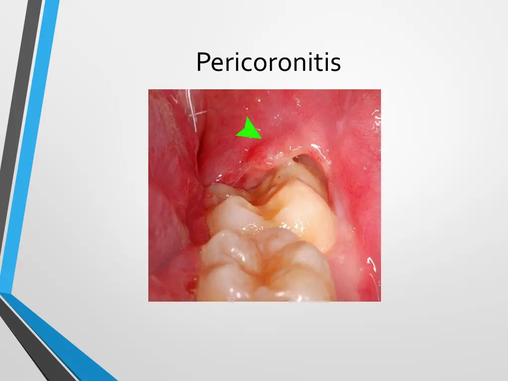 pericoronitis