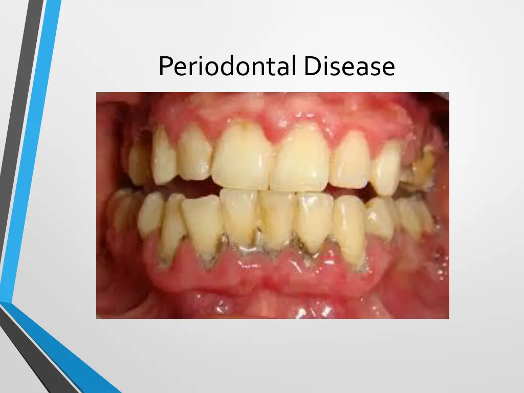 periodontal disease