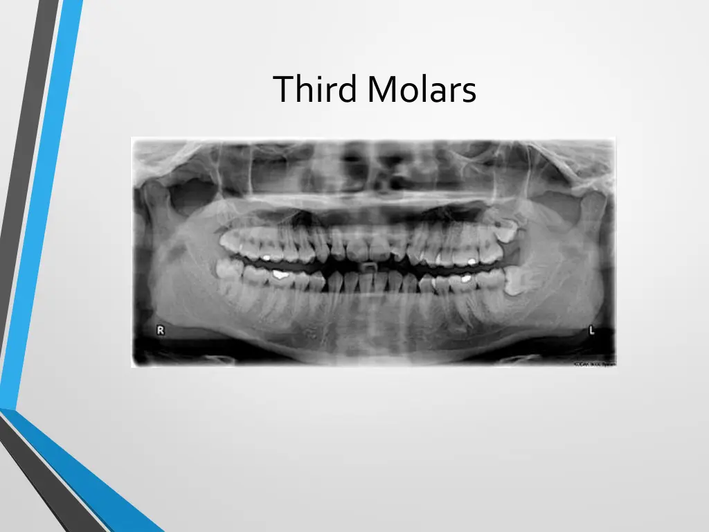 third molars