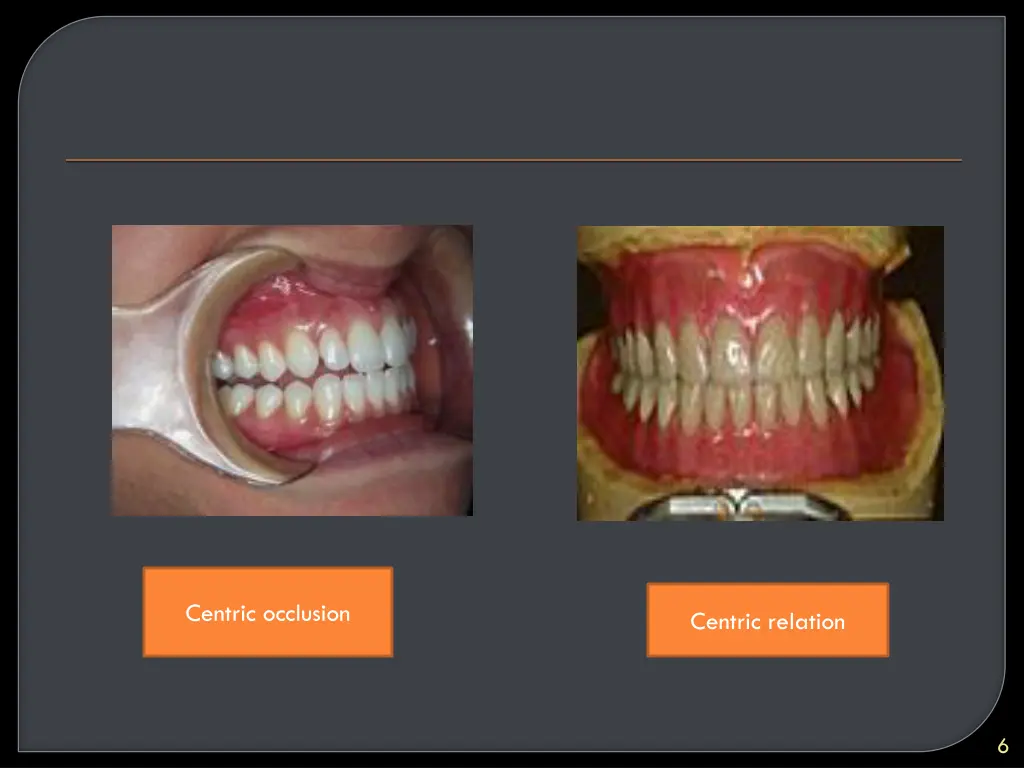 centric occlusion