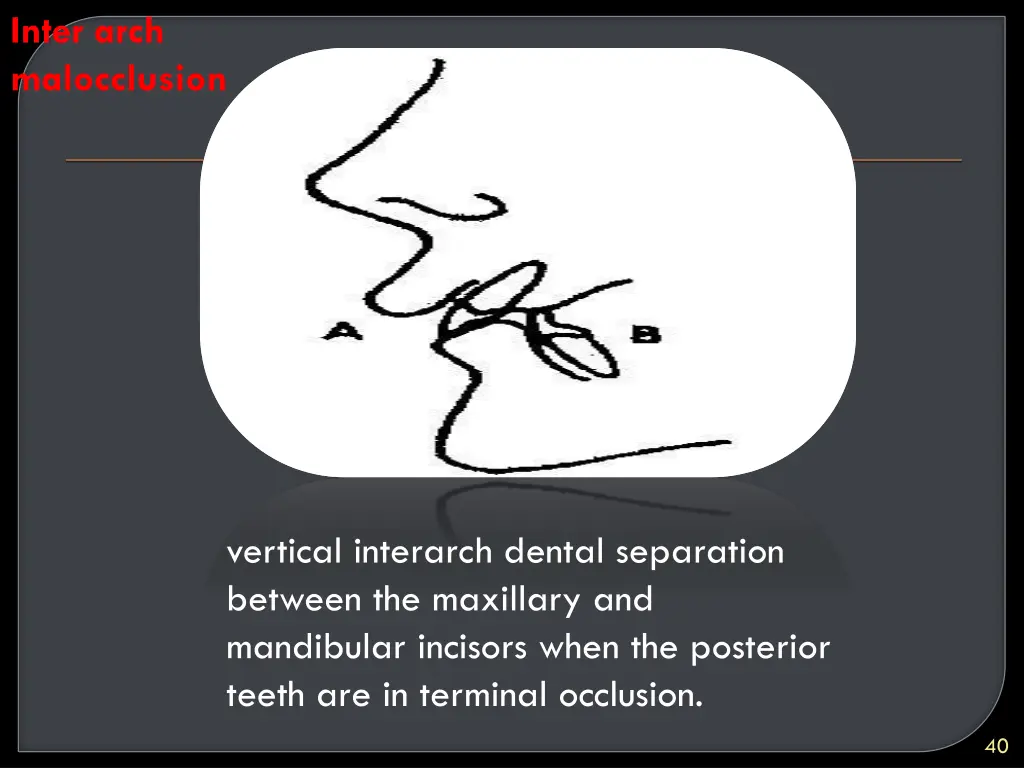 inter arch malocclusion