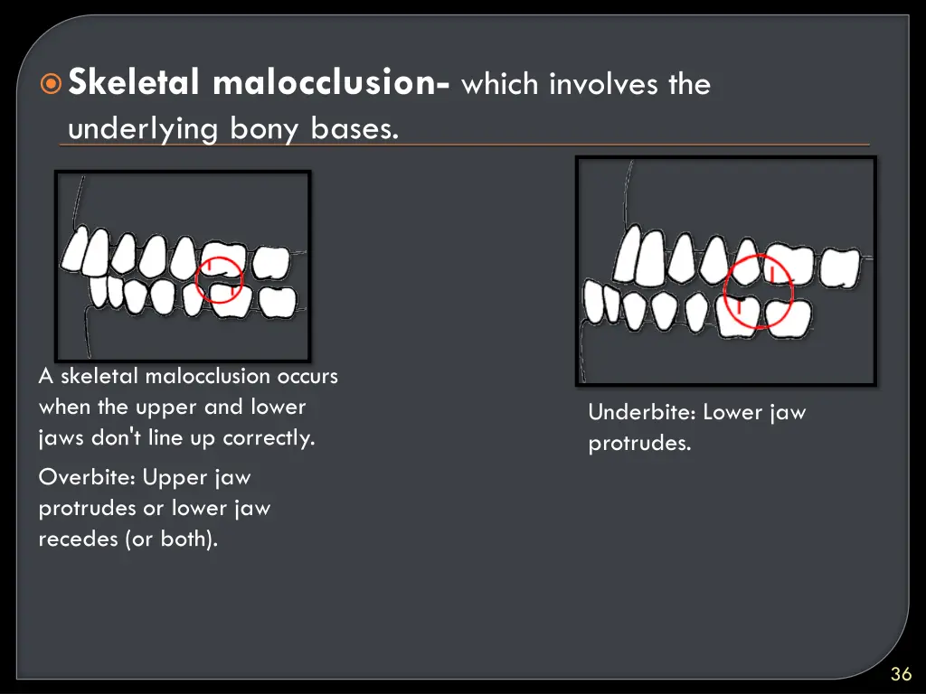 skeletal malocclusion which involves