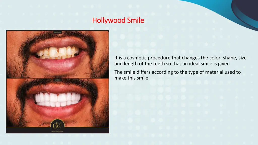 hollywood smile hollywood smile