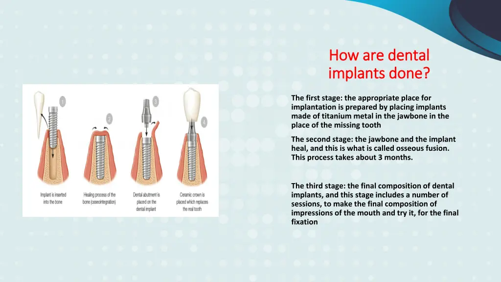 how are dental how are dental implants done