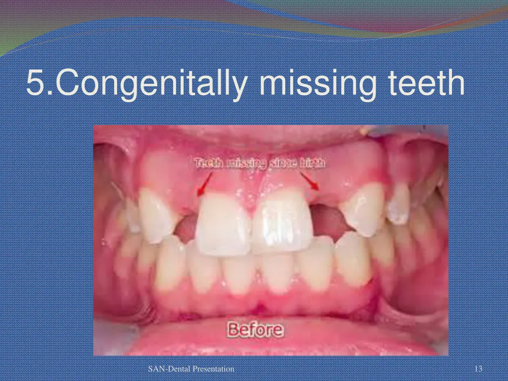 5 congenitally missing teeth