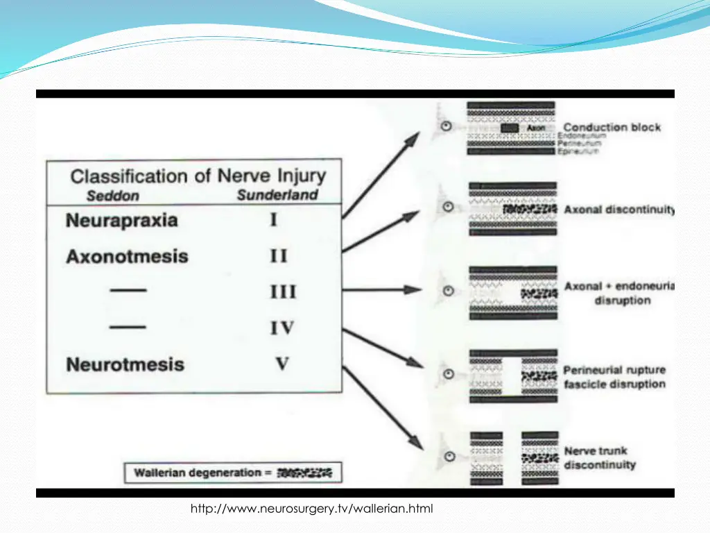 http www neurosurgery tv wallerian html