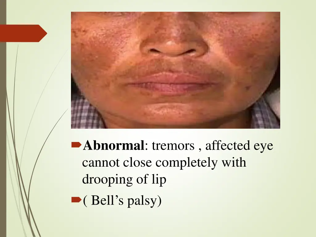 abnormal tremors affected eye cannot close