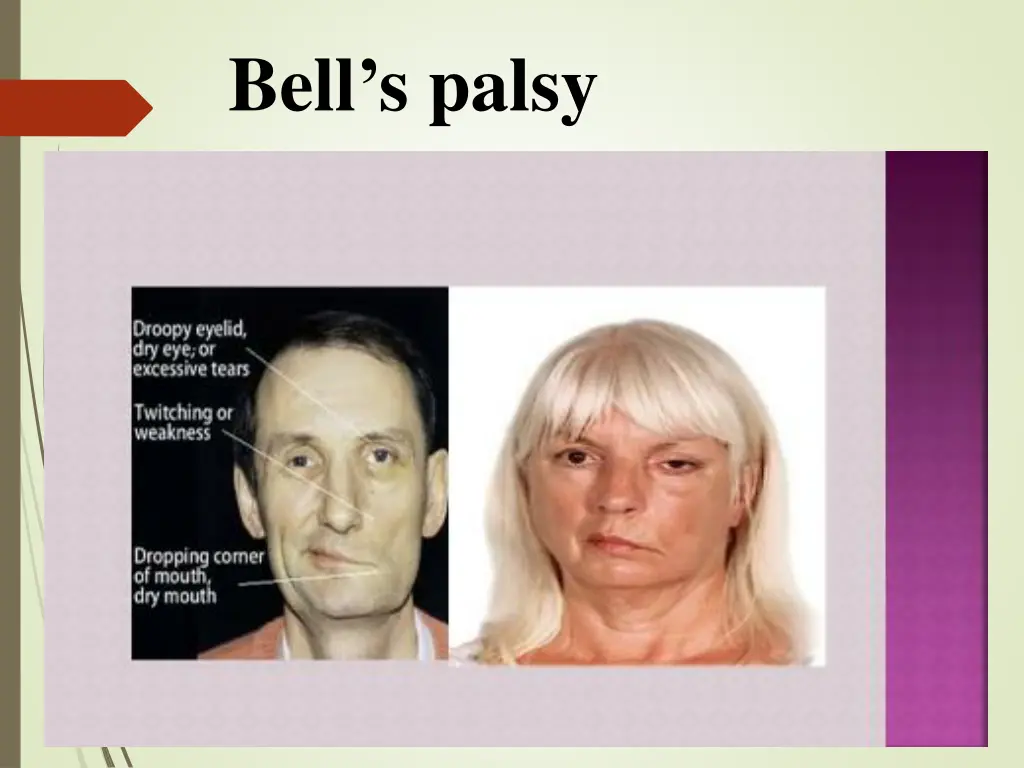 bell s palsy