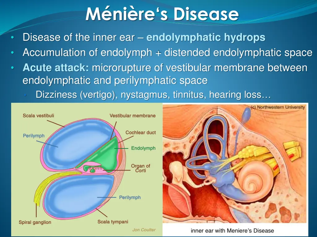 m ni re s disease