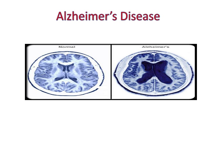 alzheimer s disease