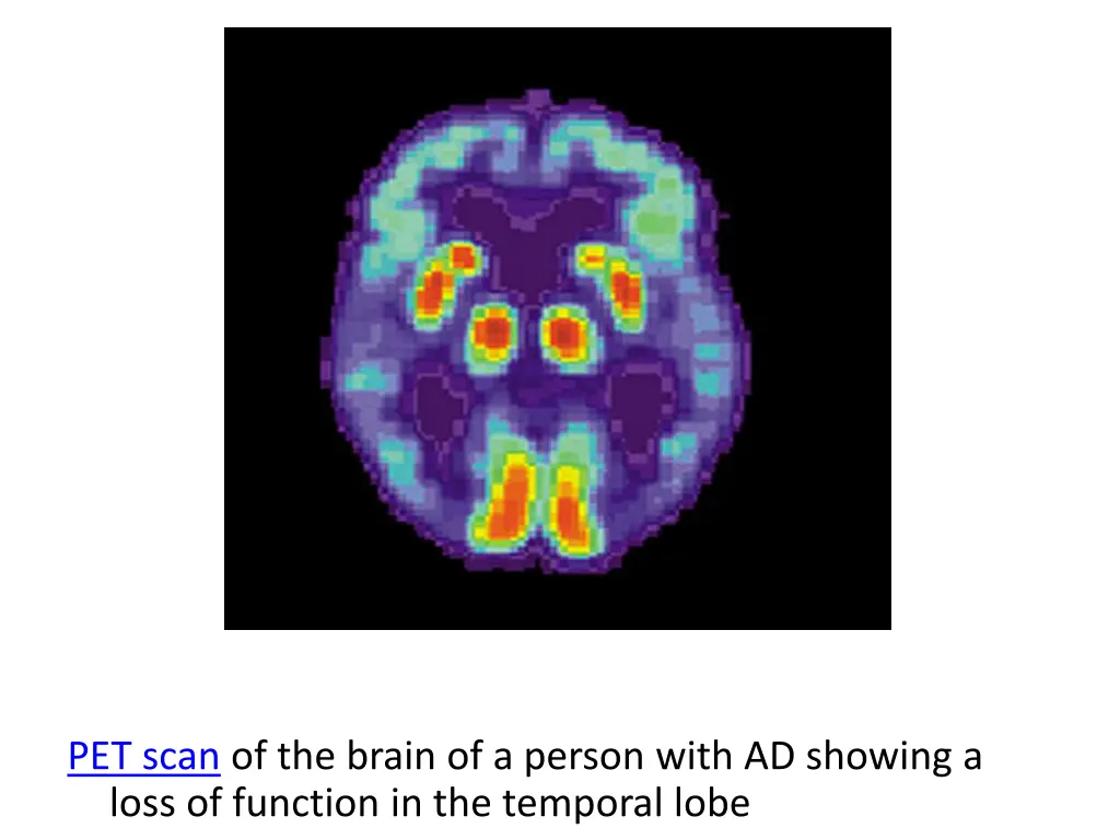 file pet alzheimer jpg