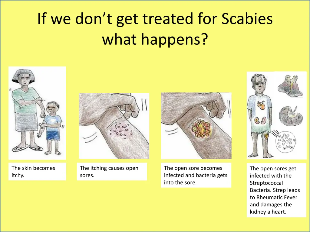 if we don t get treated for scabies what happens