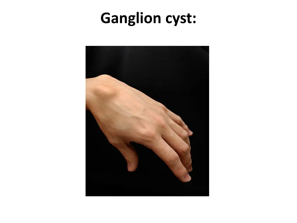 ganglion cyst