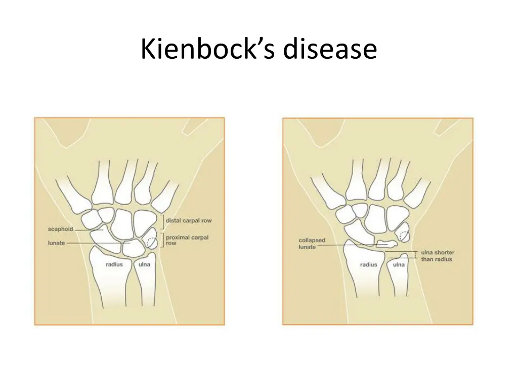 kienbock s disease