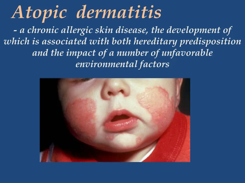 topic dermatitis a chronic allergic skin disease