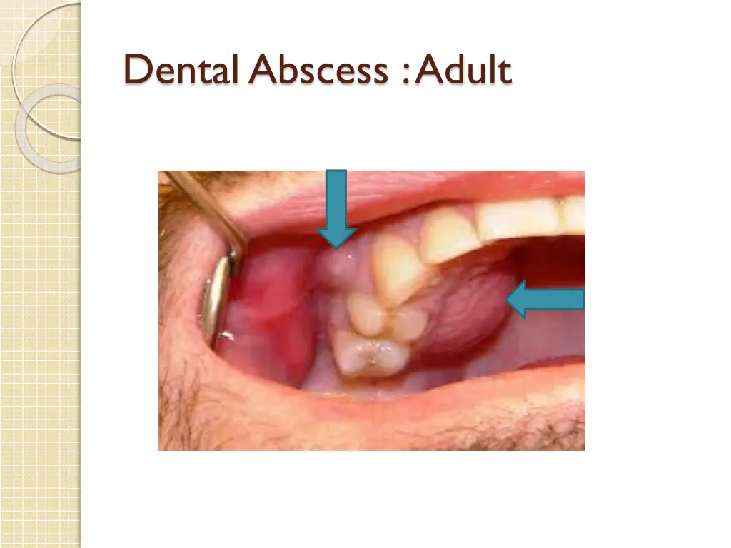 dental abscess adult