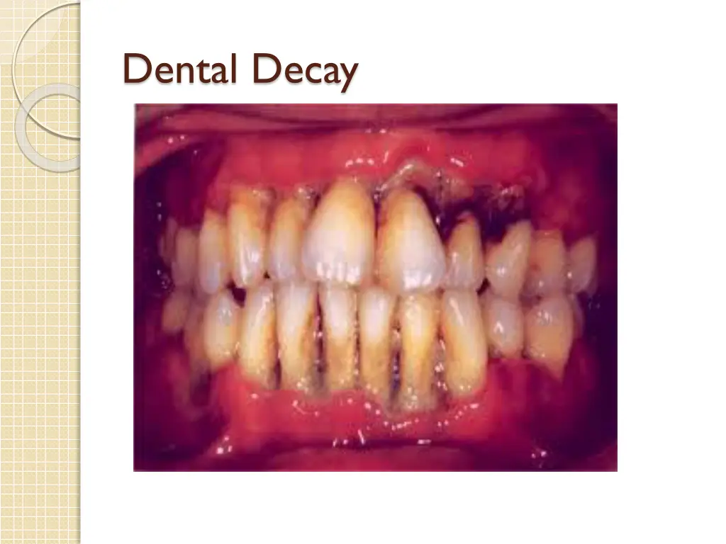 dental decay