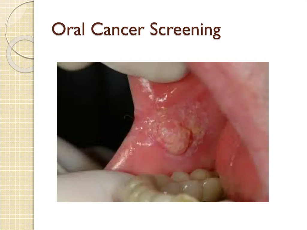 oral cancer screening