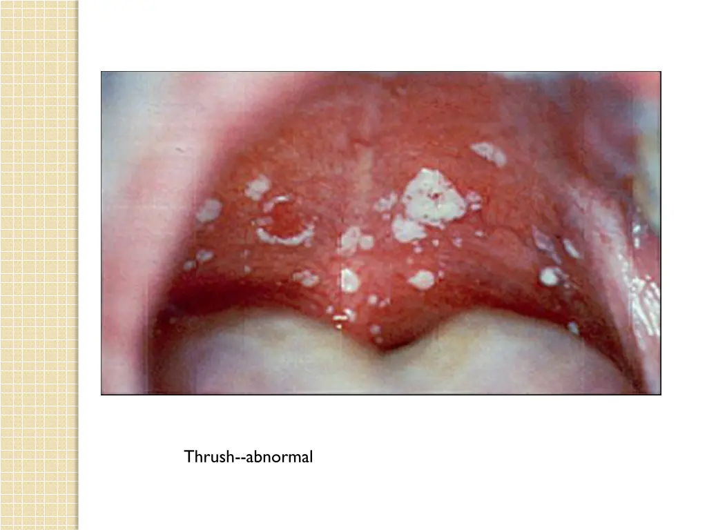 thrush abnormal