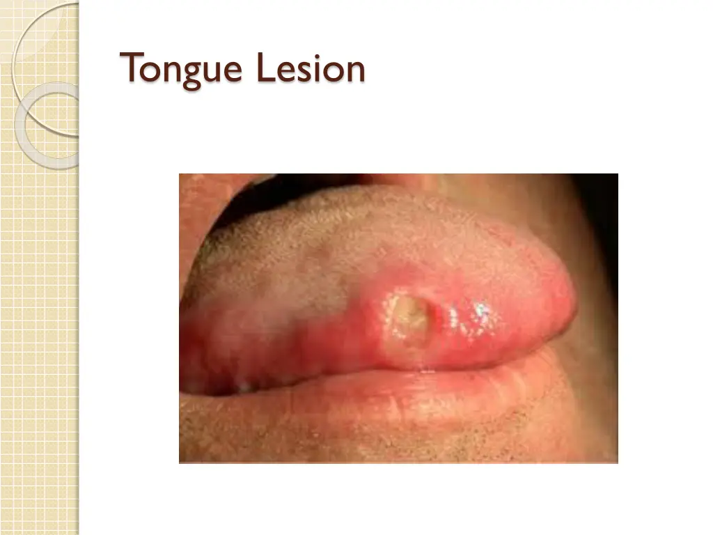 tongue lesion