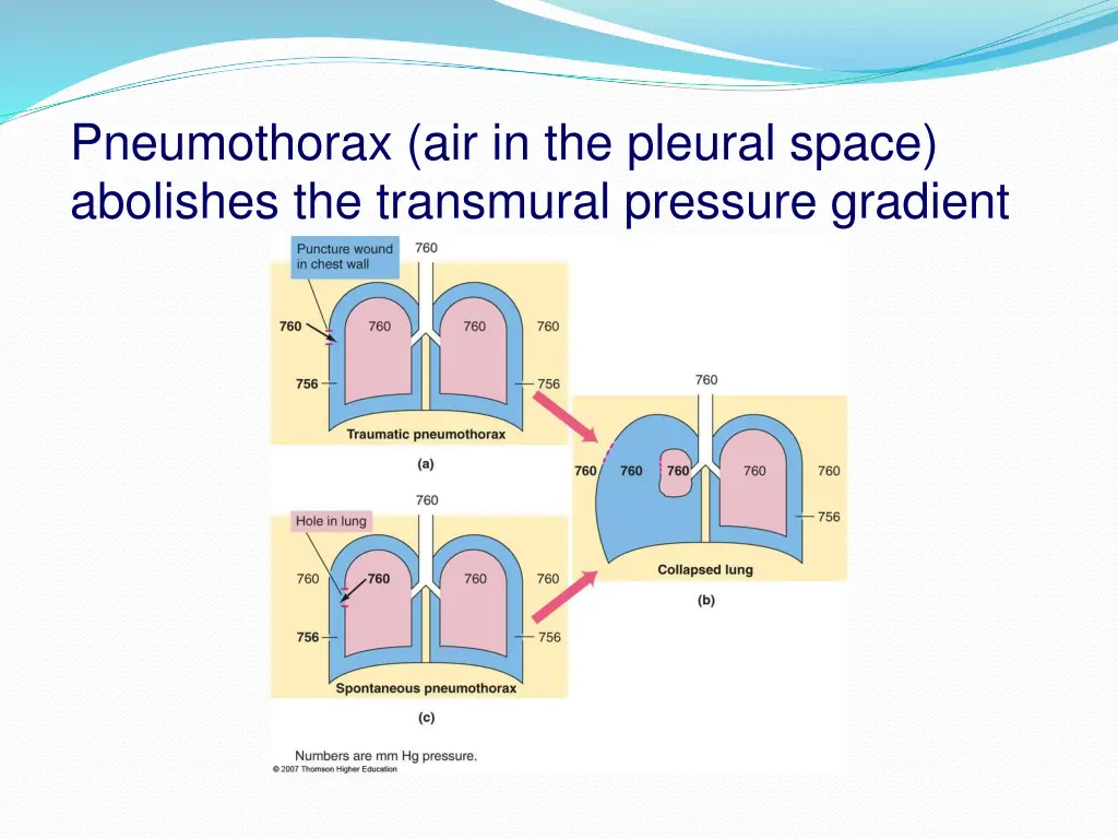 pneumothorax air in the pleural space abolishes