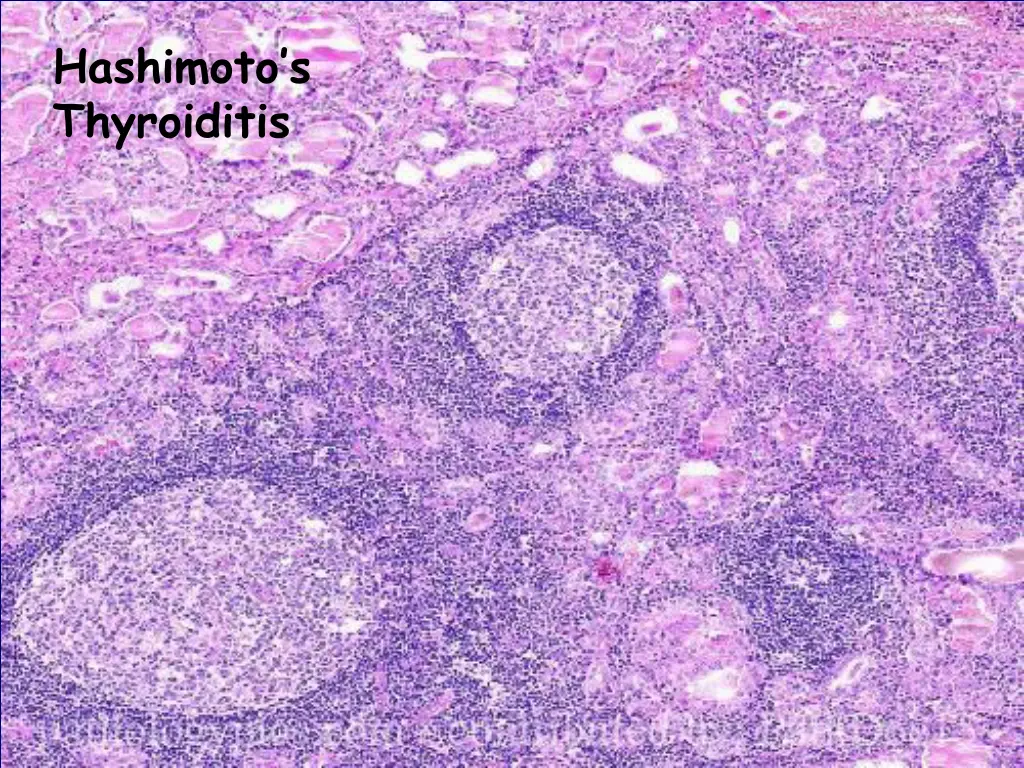 hashimoto s thyroiditis