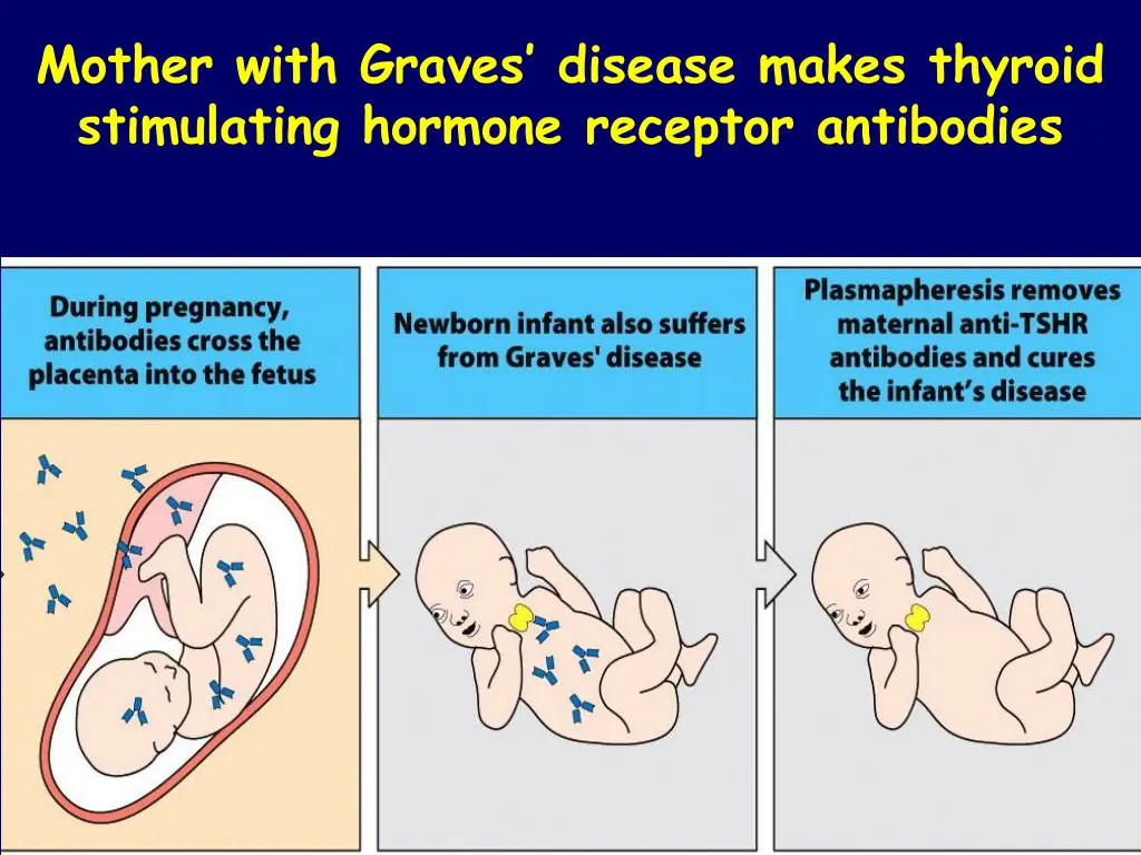 mother with graves disease makes thyroid