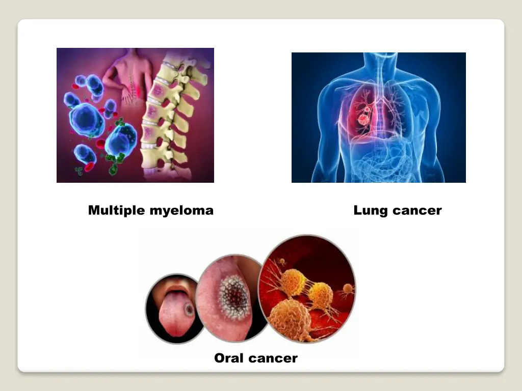 multiple myeloma