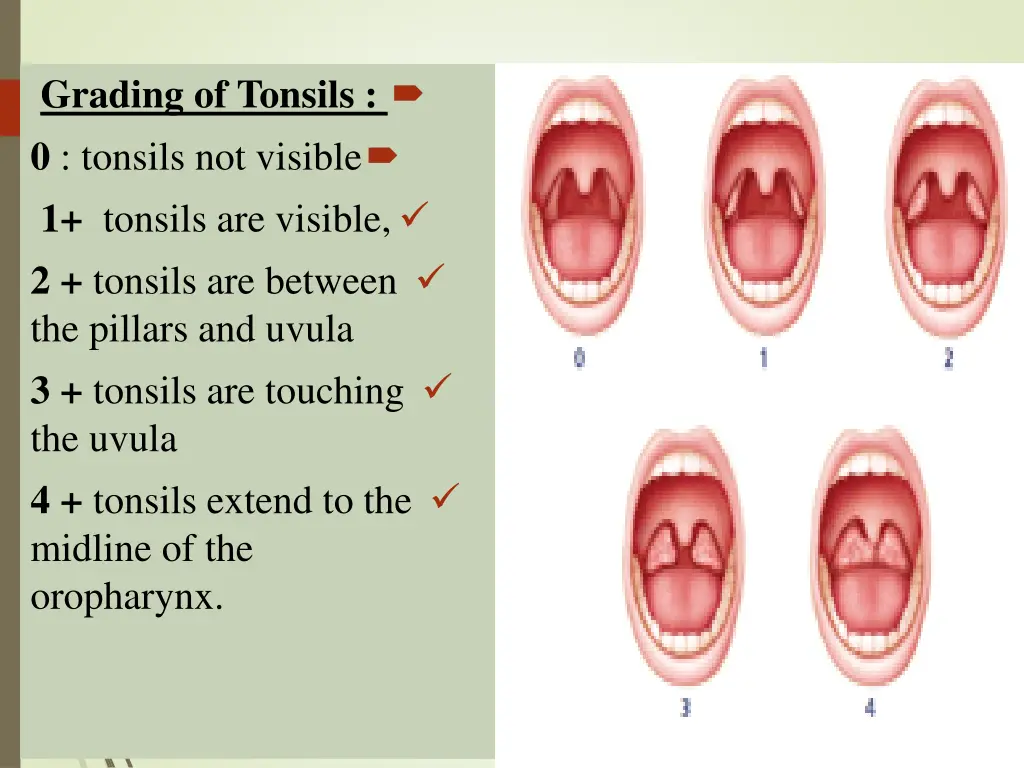 grading of tonsils 0 tonsils not visible