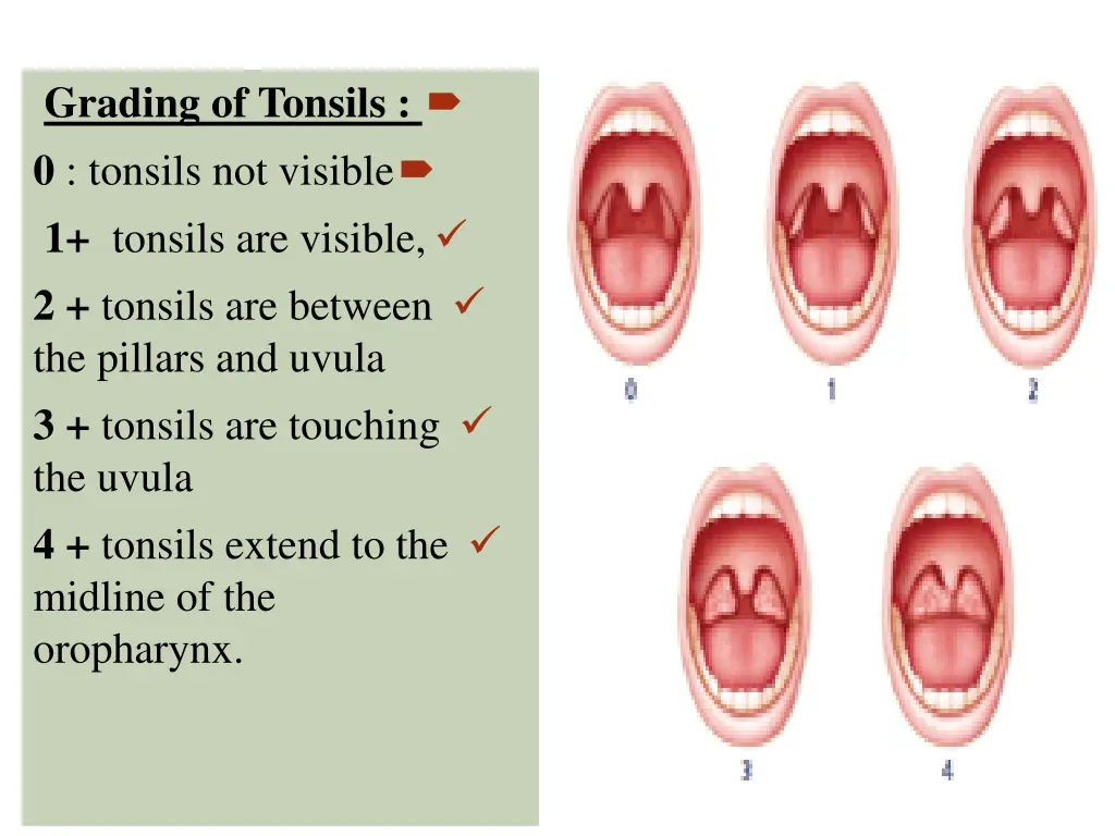 grading of tonsils 0 tonsils not visible