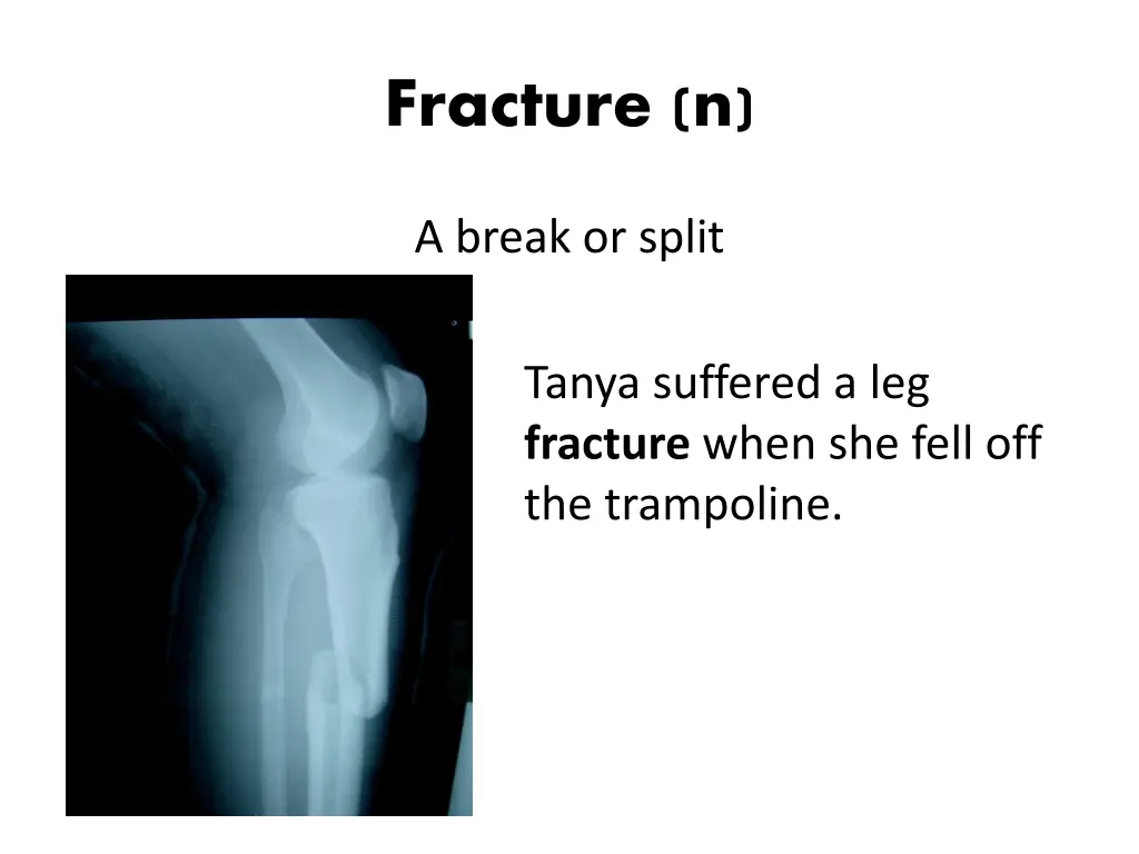 fracture n