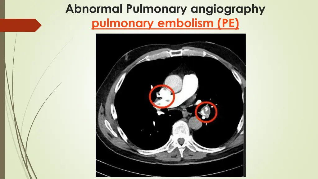 abnormal pulmonary angiography pulmonary embolism 1