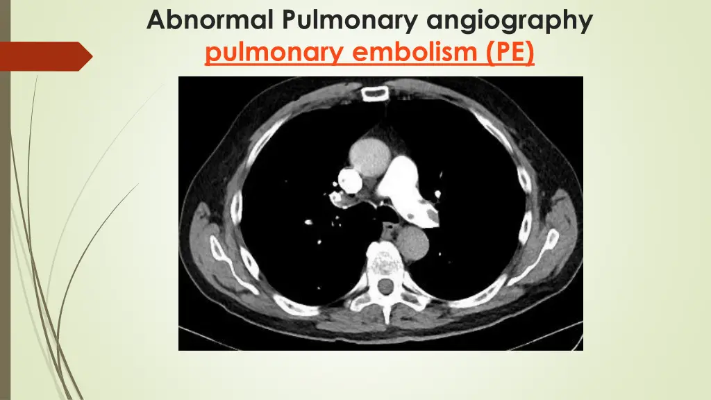 abnormal pulmonary angiography pulmonary embolism 2