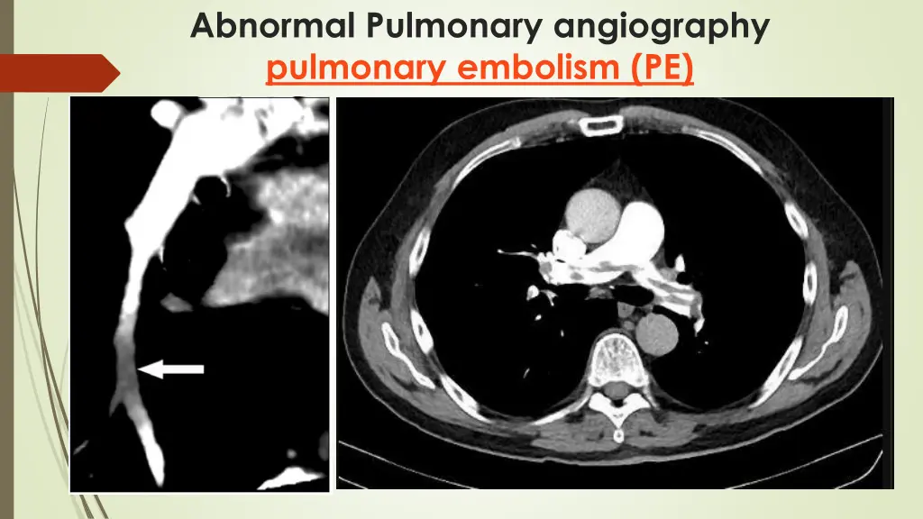 abnormal pulmonary angiography pulmonary embolism