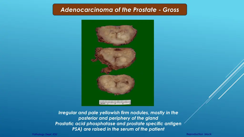 adenocarcinoma of the prostate gross