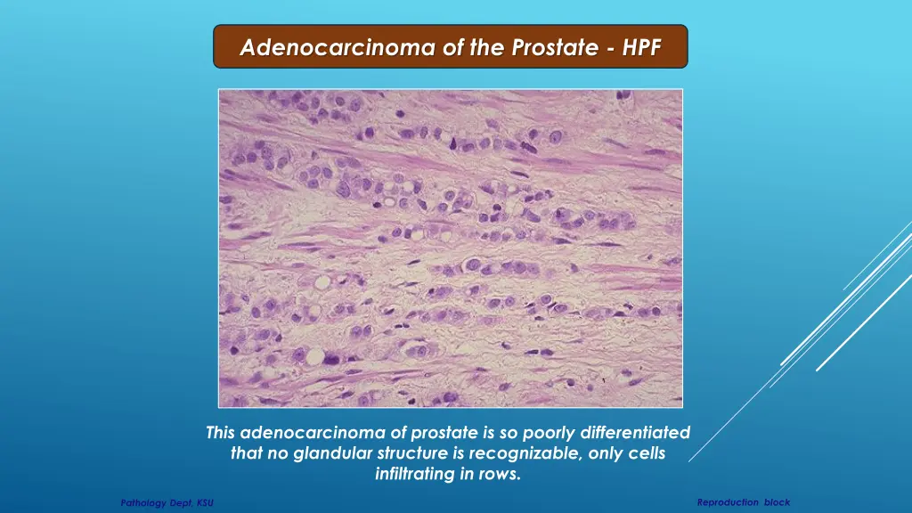 adenocarcinoma of the prostate hpf 1