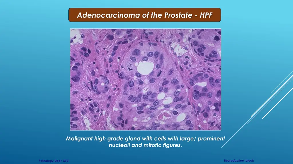 adenocarcinoma of the prostate hpf