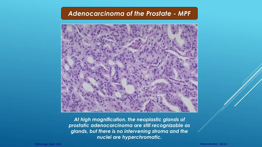 adenocarcinoma of the prostate mpf