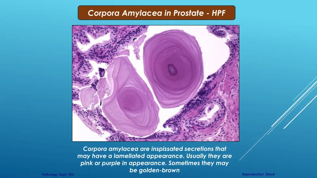 corpora amylacea in prostate hpf