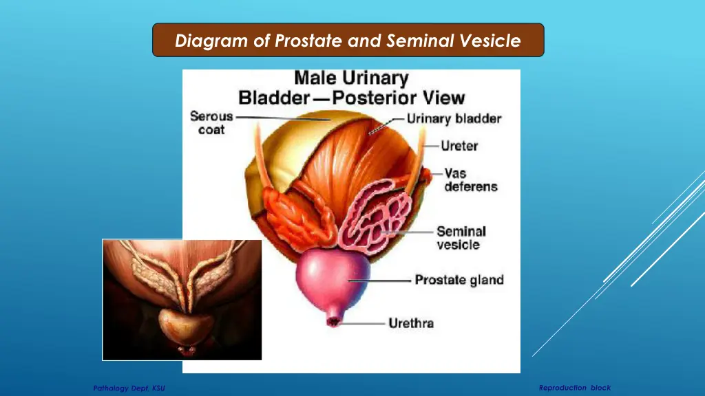 diagram of prostate and seminal vesicle