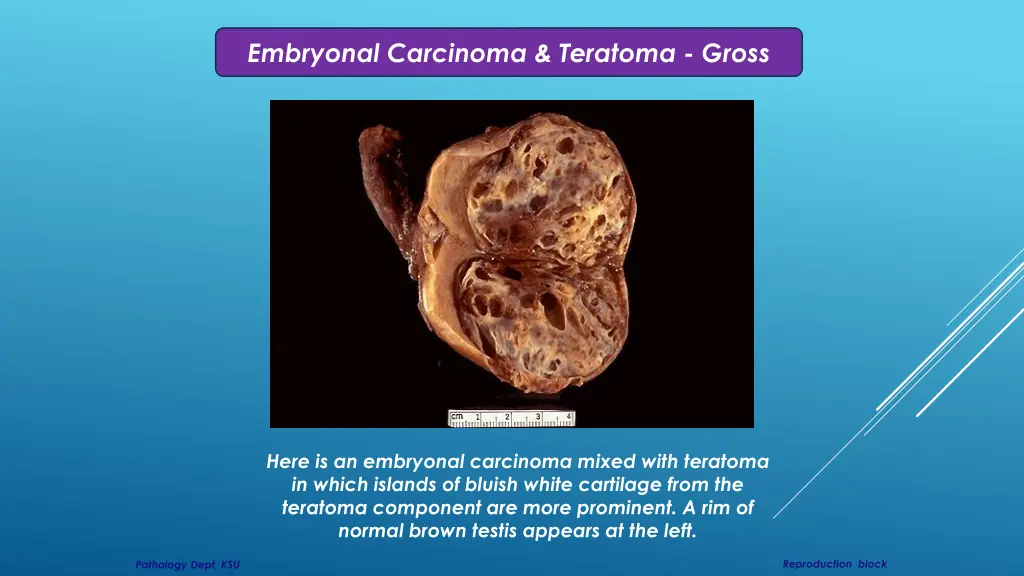 embryonal carcinoma teratoma gross