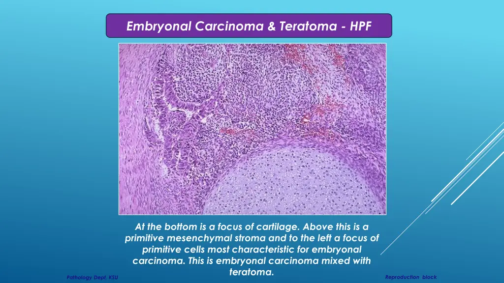 embryonal carcinoma teratoma hpf