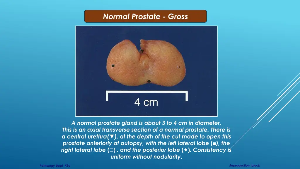 normal prostate gross