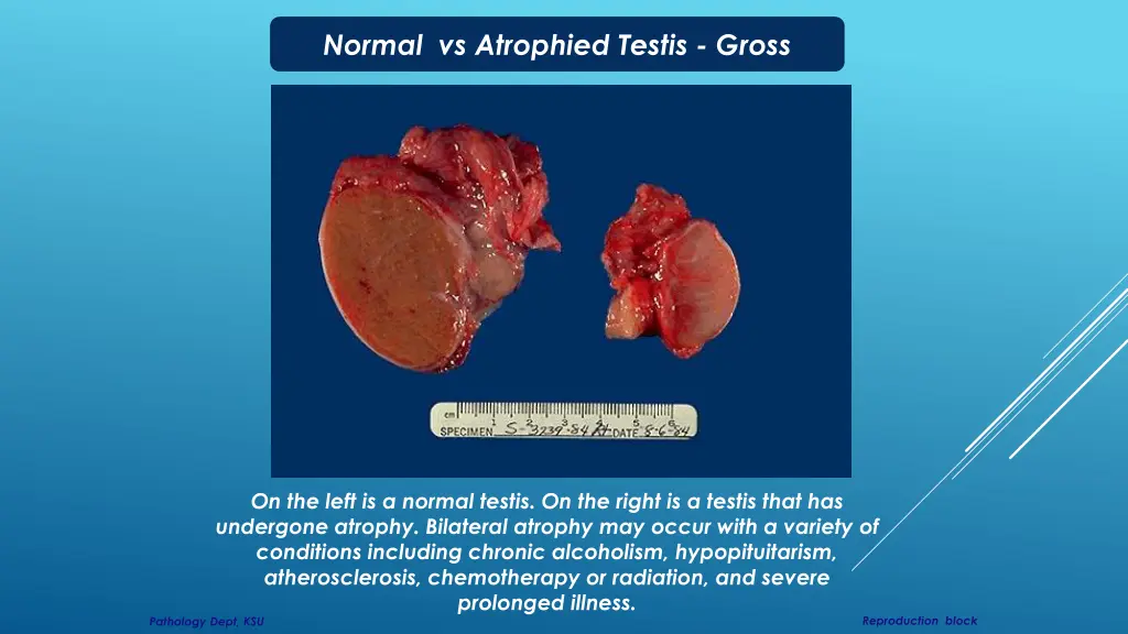 normal vs atrophied testis gross