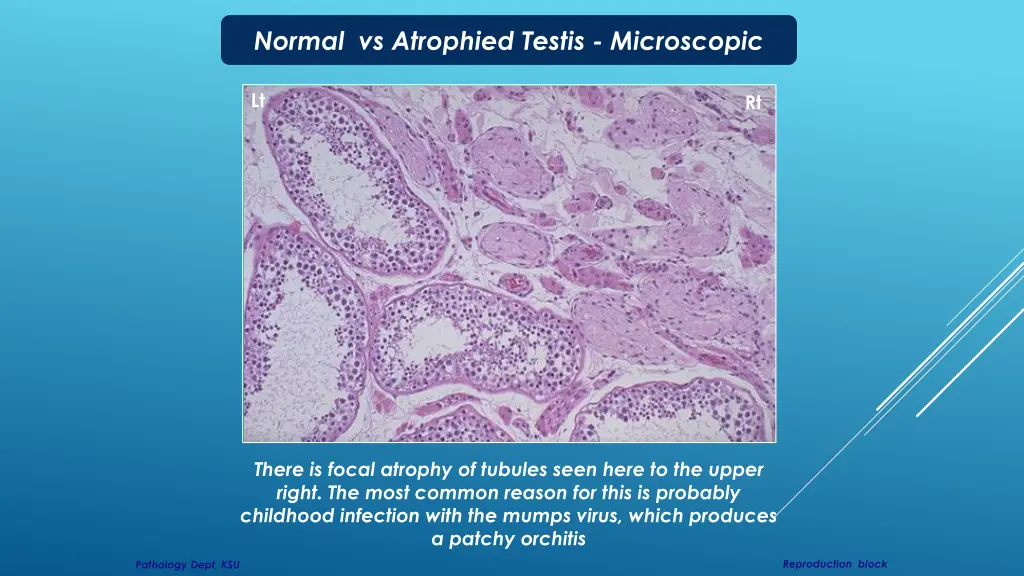 normal vs atrophied testis microscopic